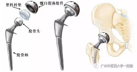 最新股骨头坏死疗法，希望之光为患者带来生活新希望